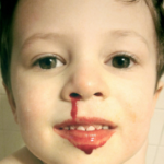 Nose Bleeds in Children