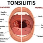 Tonsillitis – FAQs