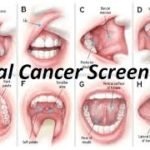 Ways to Self Assess Mouth Cancer