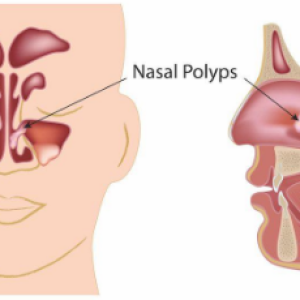 Nasal Polyps