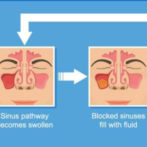 Sinusitis