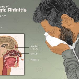 Allergic Rhinitis