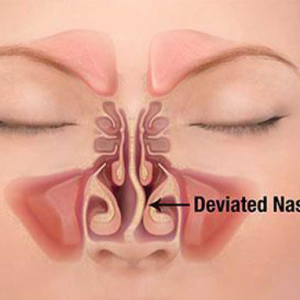 Deviated septum – FAQ