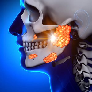 Salivary Gland Issues