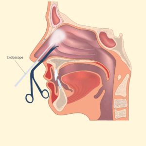 FAQs About Nose Surgery