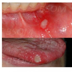 Burning mouth syndrome – FAQ